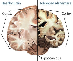 Alzheimer's and Normal Brain