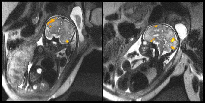 fetal brain activity