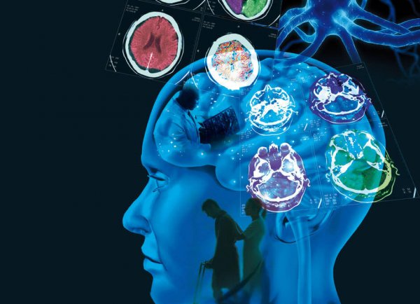 Multiple Sclerosis: Causes, Symptoms, and Treatment