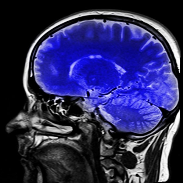 A human brain, locked-in syndrome.