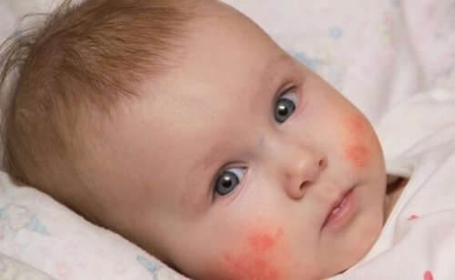 baby with atopic dermatitis
