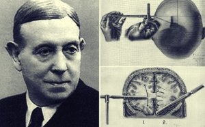 Egas Moniz and the Amazing History of the Lobotomy