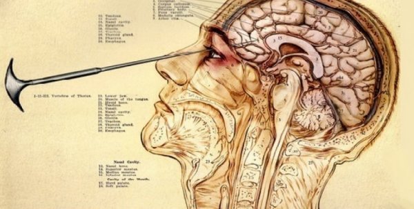 Lobotomy