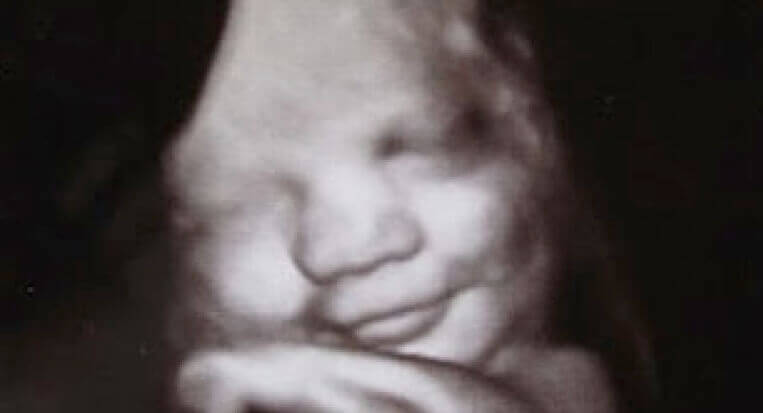 The face of a smiling fetus in a sonogram.