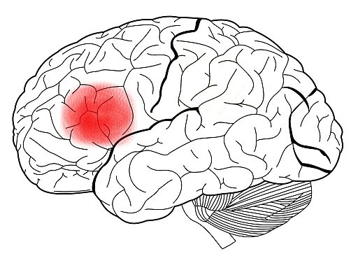 brain with the broca area highlighted in red