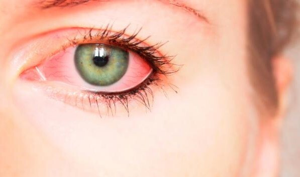 Bloodshot eyes.