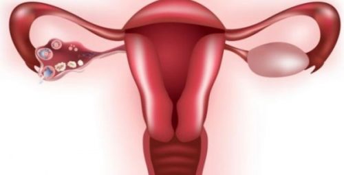 uterus and ovary with cysts