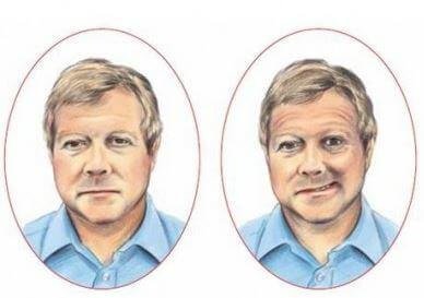 Stroke victim with an asymmetric face.