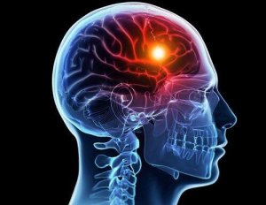 Stroke: Causes and Types