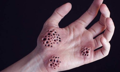 Holes in the hand and trypophobia.