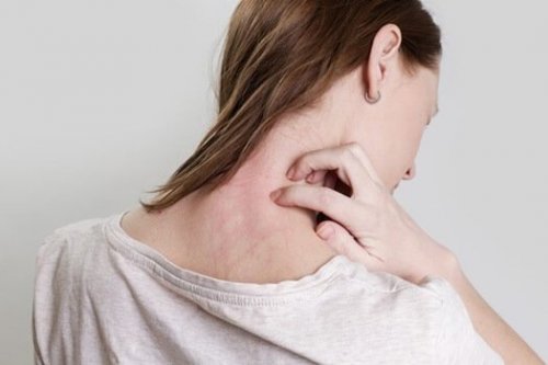 Woman with a rash.