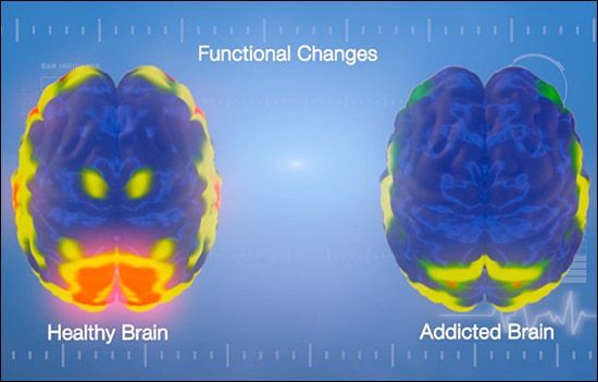 An addict's brain.