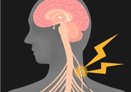 Vagus nerve stimulation.