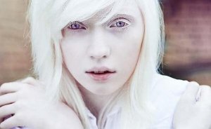 Living with Albinism: Beyond Physical Appearance