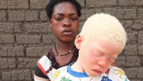 Black person behind an albino.
