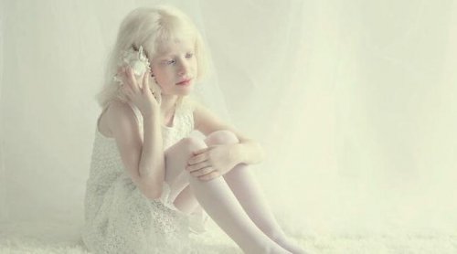 Little girl with albinism.