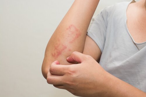 Six Tips for Treating Atopic Dermatitis