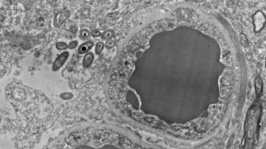 Brain Microbiome: Gut Bacteria in the Human Brain