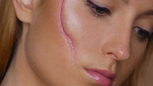 A scar is one of the facial malformations.