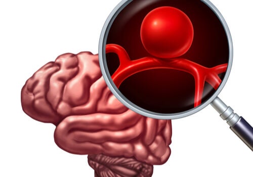 An intracranial aneurysm in the brain blown up.
