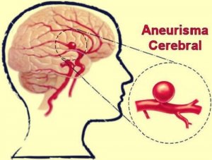 Intracranial Aneurysm