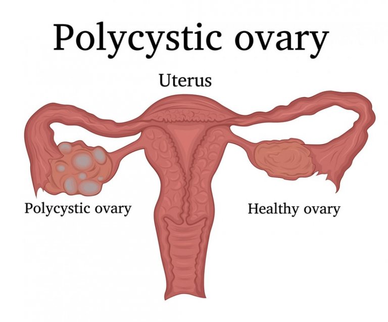 Learn All about Polycystic Ovary Syndrome
