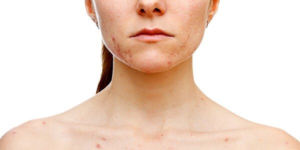 A woman with a skin condition, depicting spots, moles, and stretch marks.