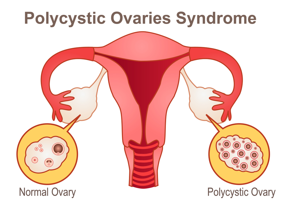 Learn All About Polycystic Ovary Syndrome Exploring Your Mind 4084