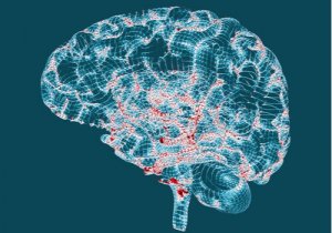 Huntington's Disease - Characteristics and Signs