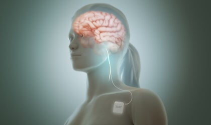 Vagus Nerve Stimulation Reduces Depression Symptoms