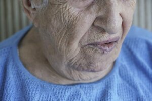 Facial Paralysis: Causes and Treatments