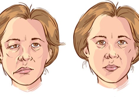 An illustration of a woman with facial paralysis.