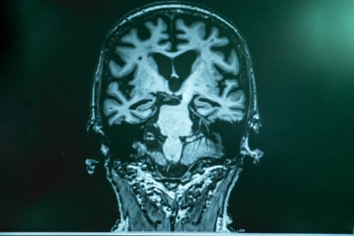 A brain with Alzheimer's.