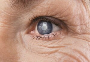 Cataract Surgery - How Does the Brain Process Visual Changes?