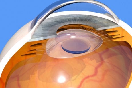 An intraocular lens on an eye.