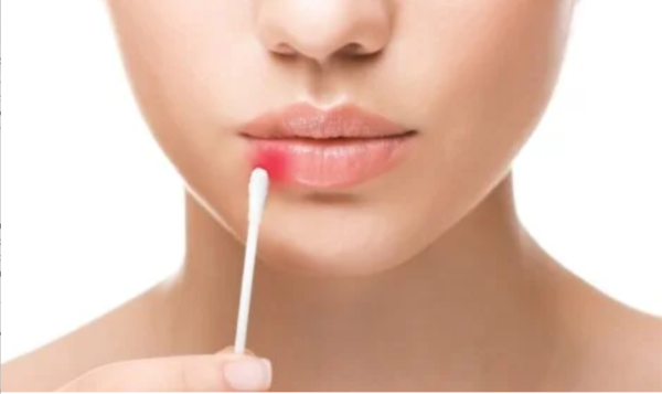 Herpes or cold sore due to stress.