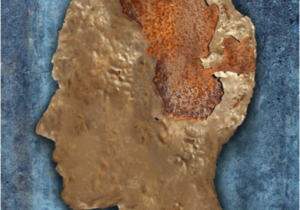 Mad Cow Disease or Spongiform Encephalopathy