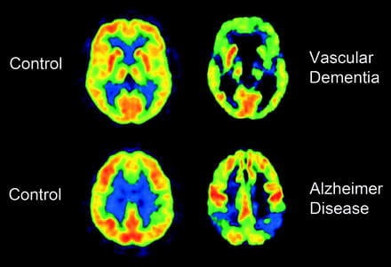 Vascular dementia.