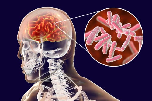 De classificatie van herseninfecties en hun symptomen