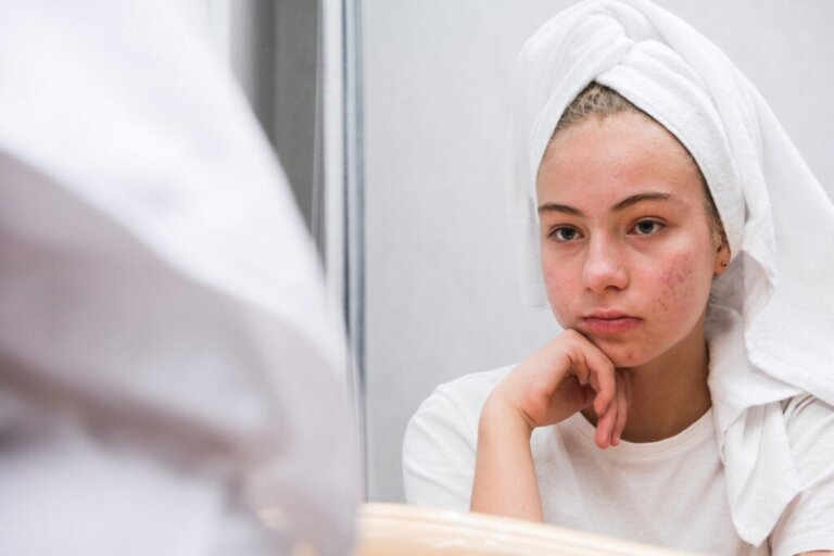 The Psychological Impact of Acne in Adolescence