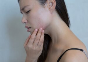 The Effects of Stress on Your Skin