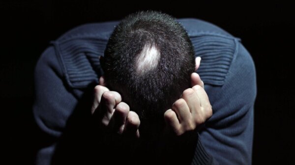 The Link Between Alopecia Areata and Stress
