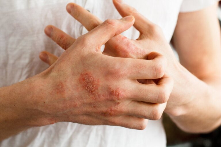 Neurodermatitis: Causes, Symptoms, and Treatment