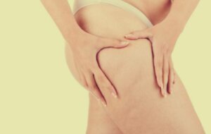 Lipedema: Beyond Obesity