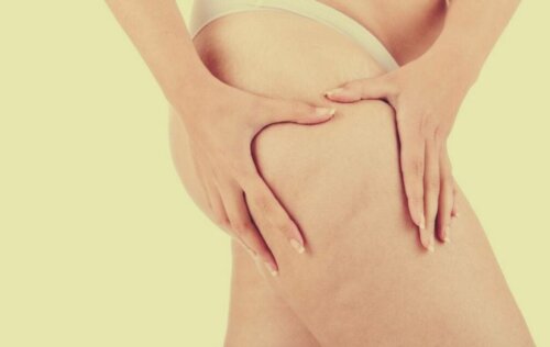 Lipedema: Beyond Obesity